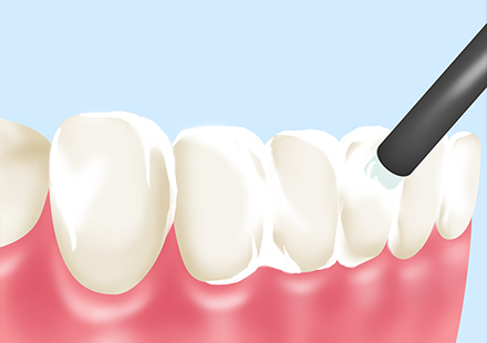 エクラで行う予防歯科のポイント