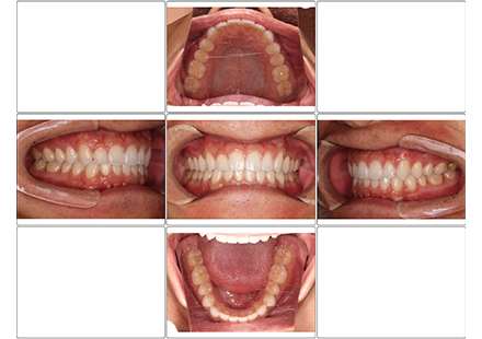 インビザライン非抜歯、IPRのみ