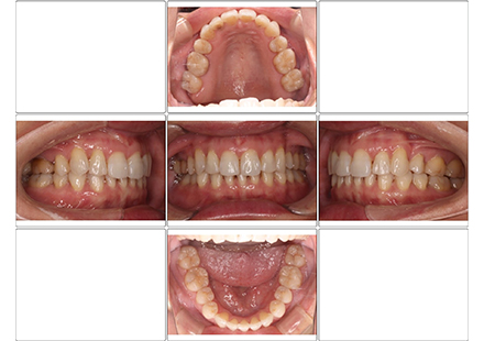 上顎4/4抜歯　セクショナル後インビザライン
