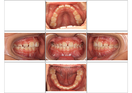 1期治療　QH、リンガルアーチ