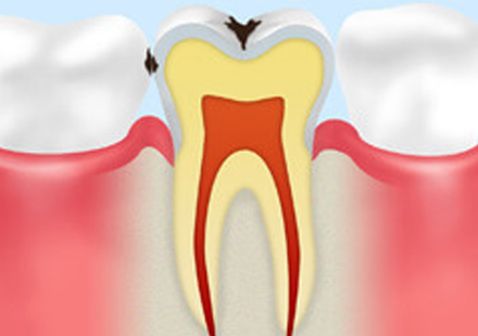 C1：エナメル質の虫歯