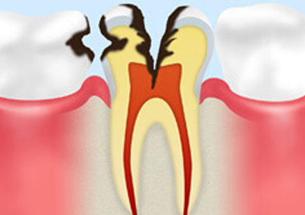 C2：象牙質の虫歯
