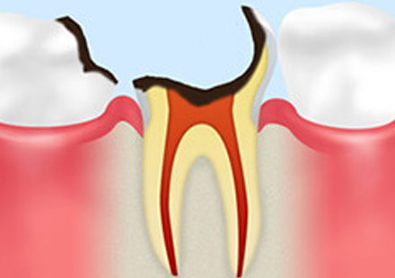 C3：神経まで達した虫歯