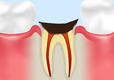 C4：末期の虫歯