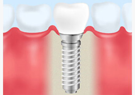 インプラント