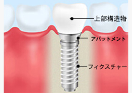 インプラント