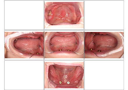 治療後（入れ歯を外した時）