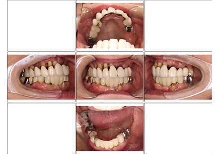 上顎金属床、下顎ミラクルデンチャー