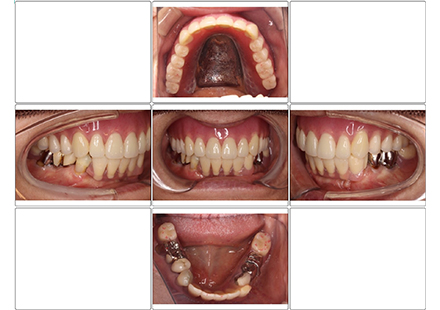 上顎金属床、下顎ミラクルデンチャー