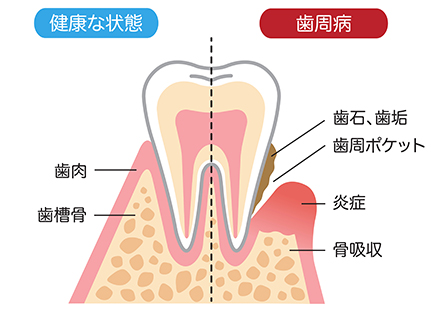 歯周病に悩まないために……原因から探りましょう